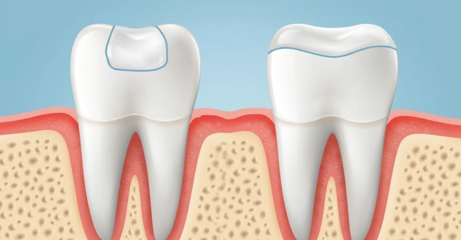 Dental Inlays vs Onlays inbog